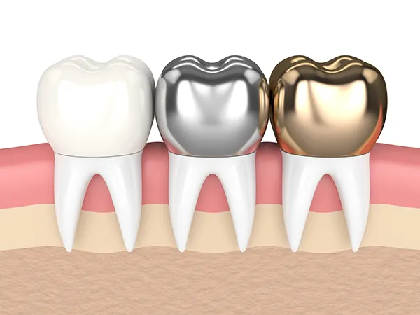 3D rendered cross-section view of three teeth with dental crowns made of different materials Auburn, MA
