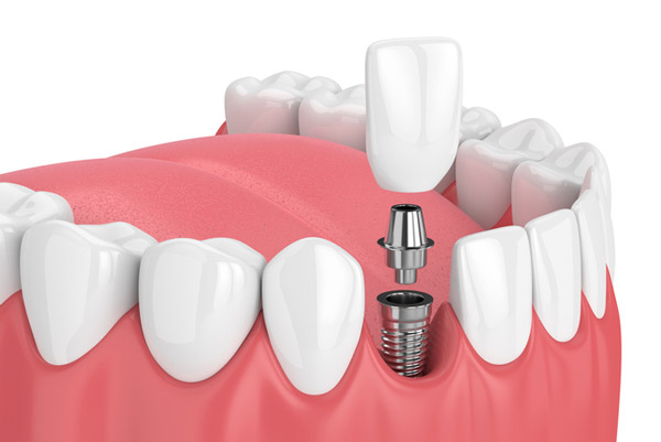 a 3D rendering of a dental implant post, abutment, and crown at D.A. Dental in Auburn, MA