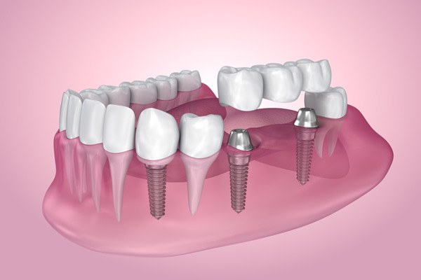 3D rendering of mouth with multiple dental implants at D.A. Dental in Auburn, MA