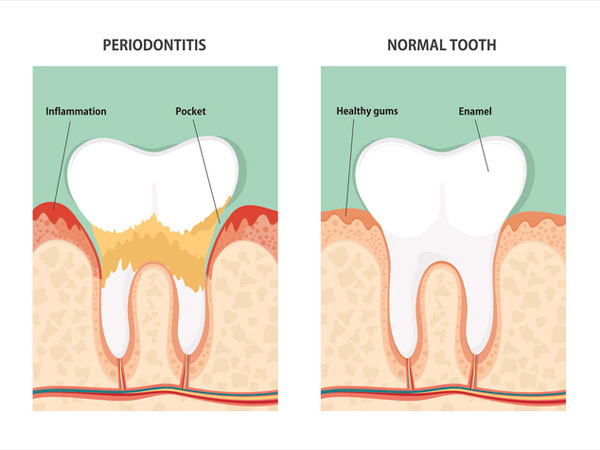 Diagram of what periodontitis looks like and what a healthy tooth looks like, demonstrated by D.A. Dental in Auburn, MA