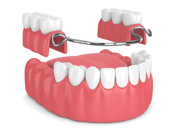 Rendering of removable partial denture at D.A. Dental in Auburn, MA