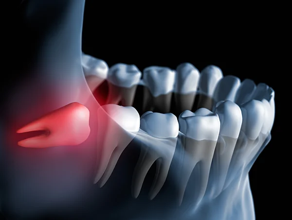 3D rendered xray of an impacted wisdom tooth butting against the tooth next to it at D.A. Dental in Auburn, MA