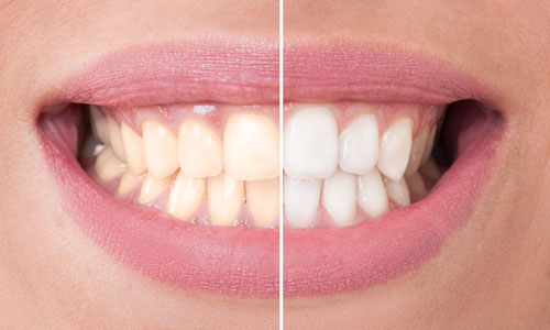 Close up comparison of before and after teeth whitening treatment on a woman’s smile at D.A. Dental in Auburn, MA
