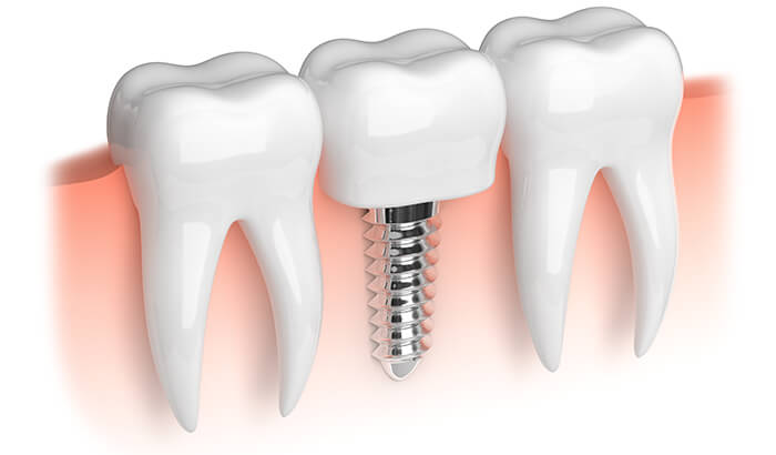image of teeth doe dental implants