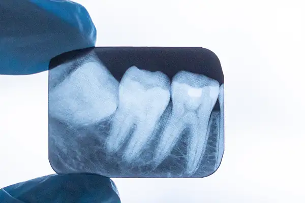 A close-up of a dental X-ray showing the position and alignment of an impacted wisdom tooth at D.A. Dental in Auburn, MA