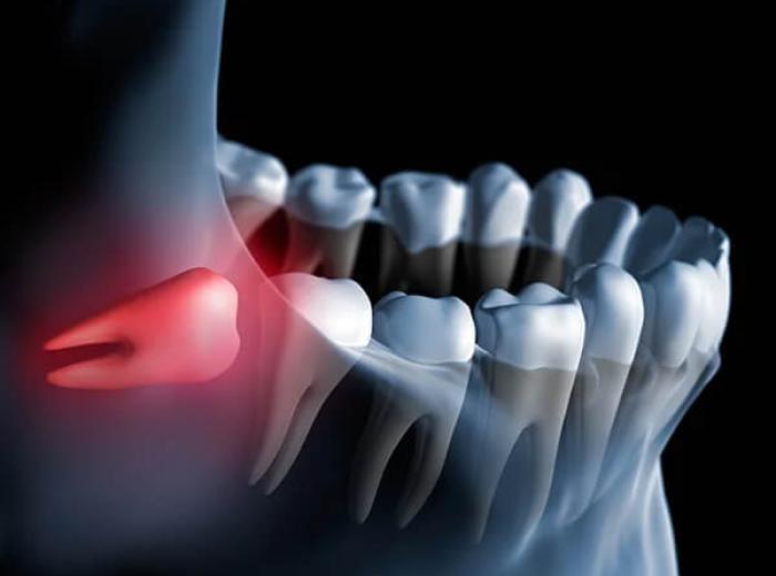 Impacted Wisdom Teeth Auburn, MA