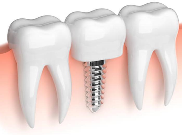 Dental Implant Guide in Auburn, MA